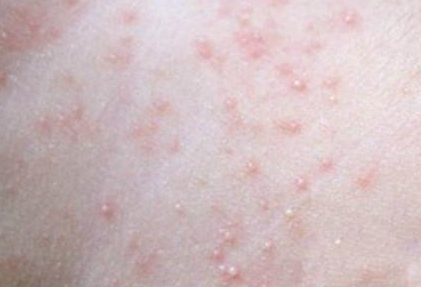 疱疹和水泡的区别图片?